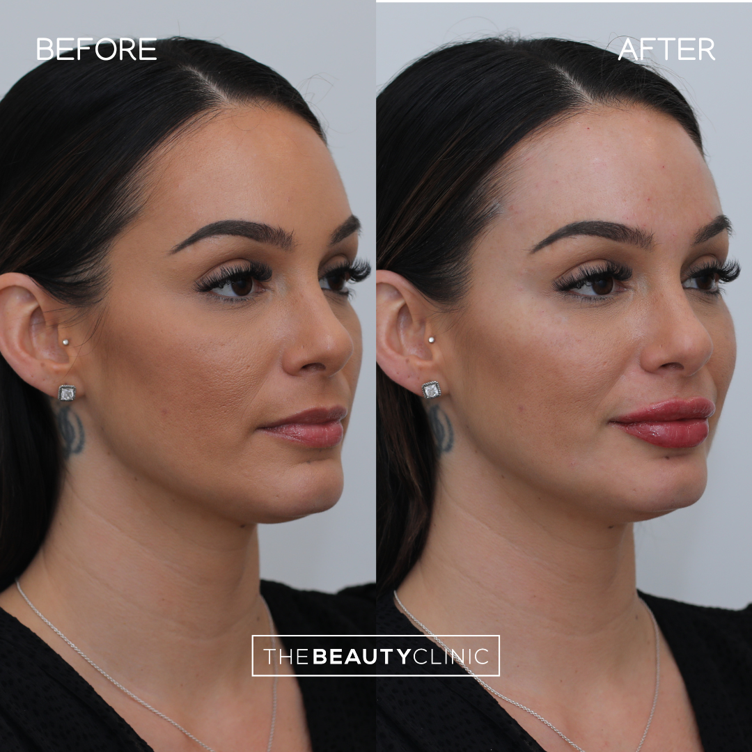 Lip Filler - Before and After - The Beauty Clinic