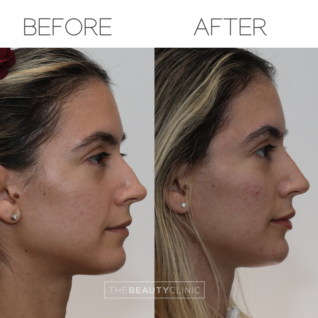 The beauty clinic - Facial Balancing with Filler - Before and after - filler