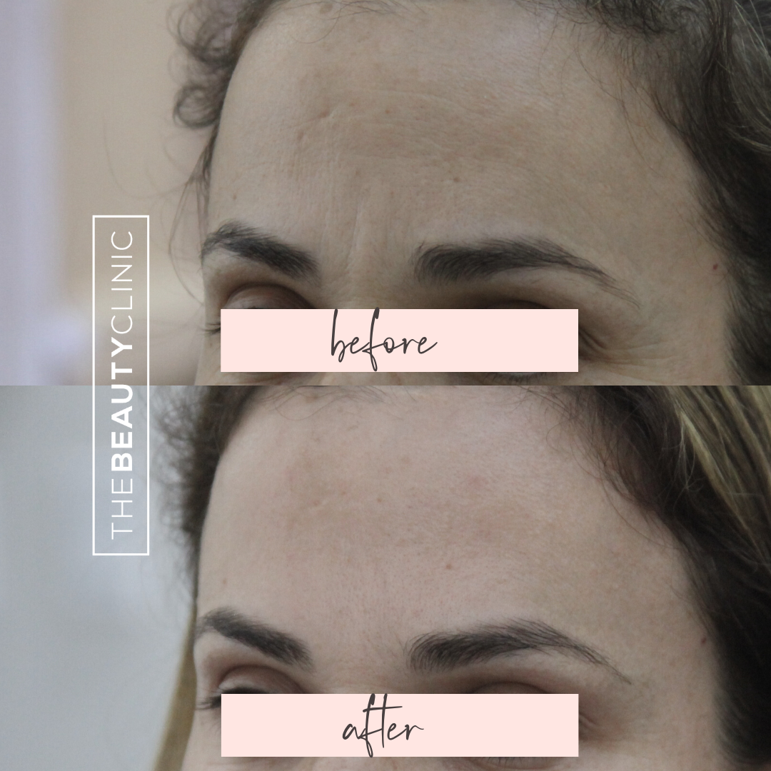 The Beauty Clinic - Toxins - Before and After