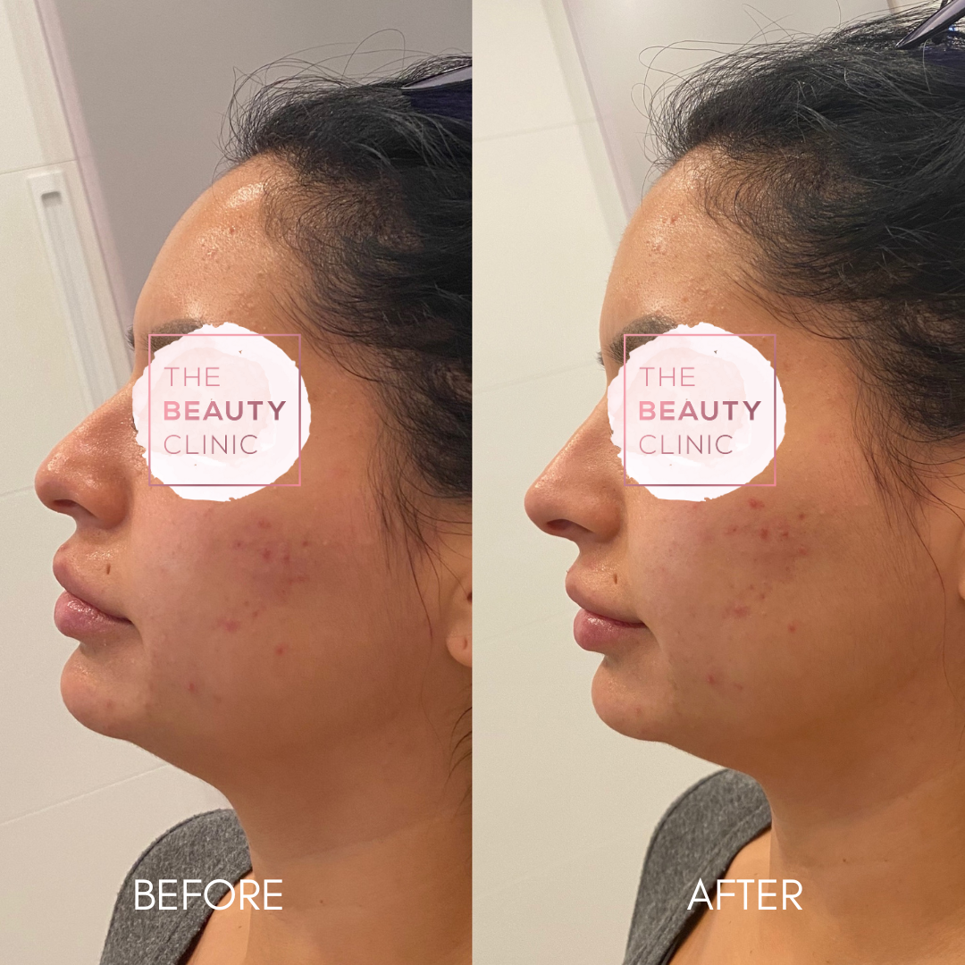 Nose Filler - Before and After - The Beauty Clinic