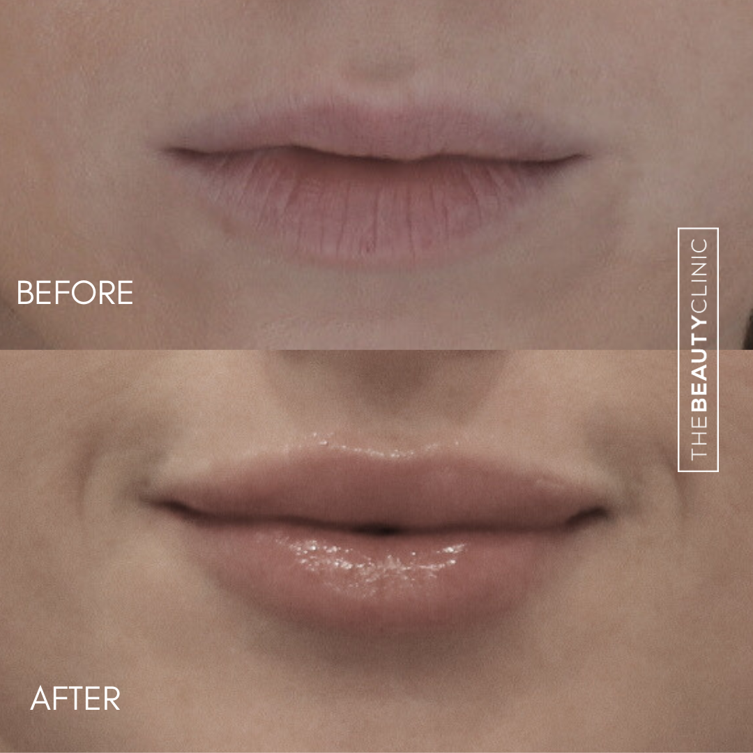 Lip Filler - Before and After - The Beauty Clinic