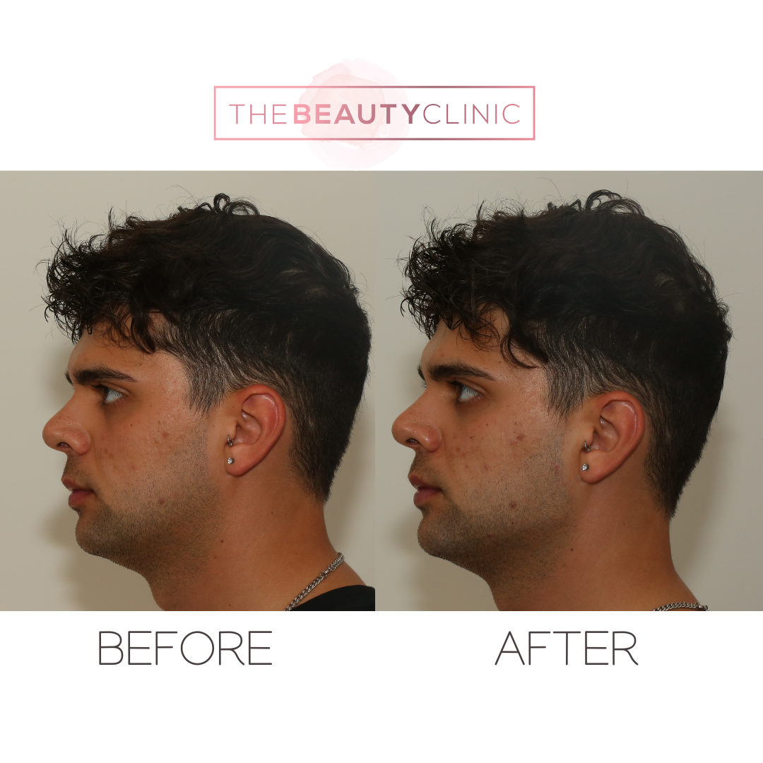 Jawline filler - Before and after - The Beauty Clinic