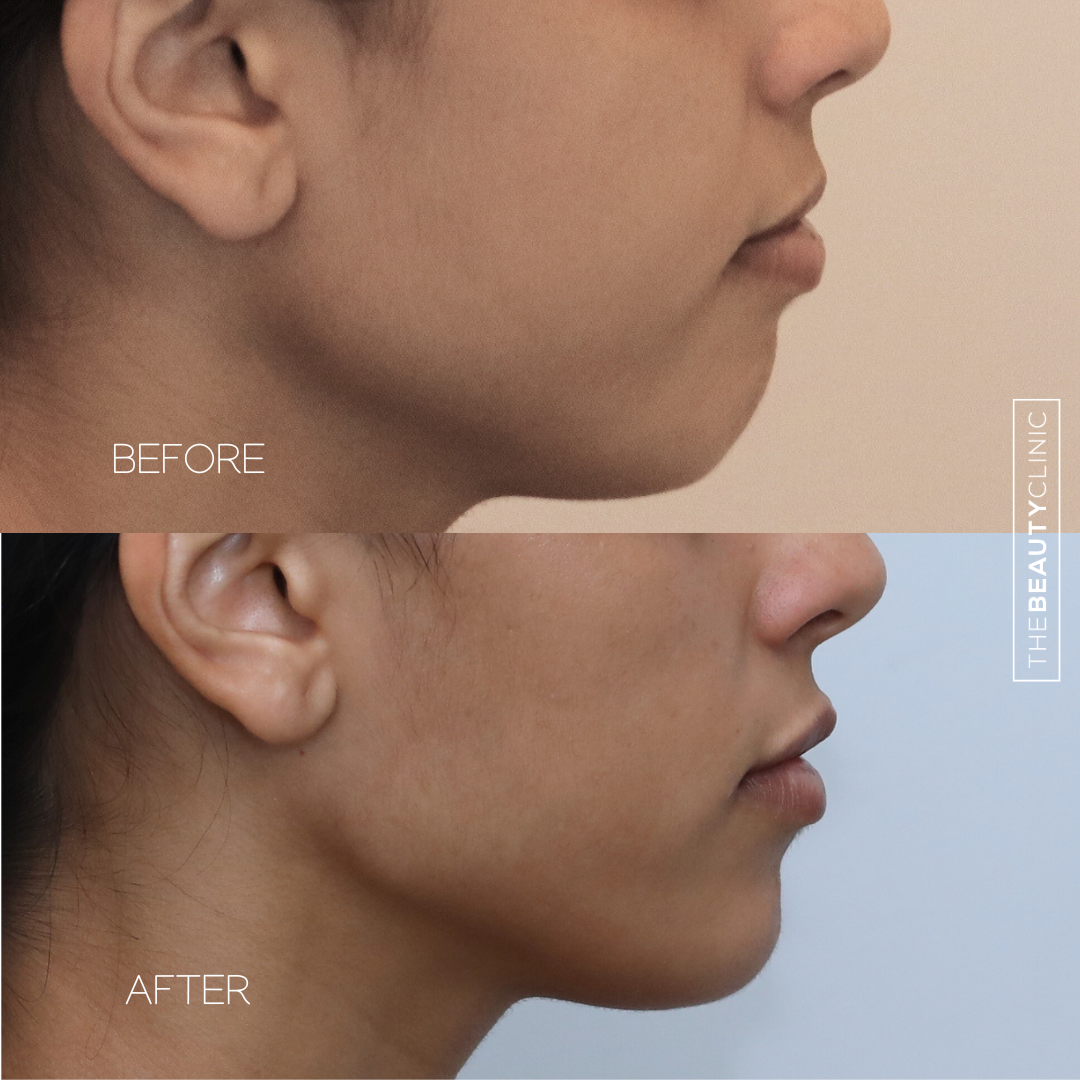 Chin filler - Before and after - The Beauty Clinic