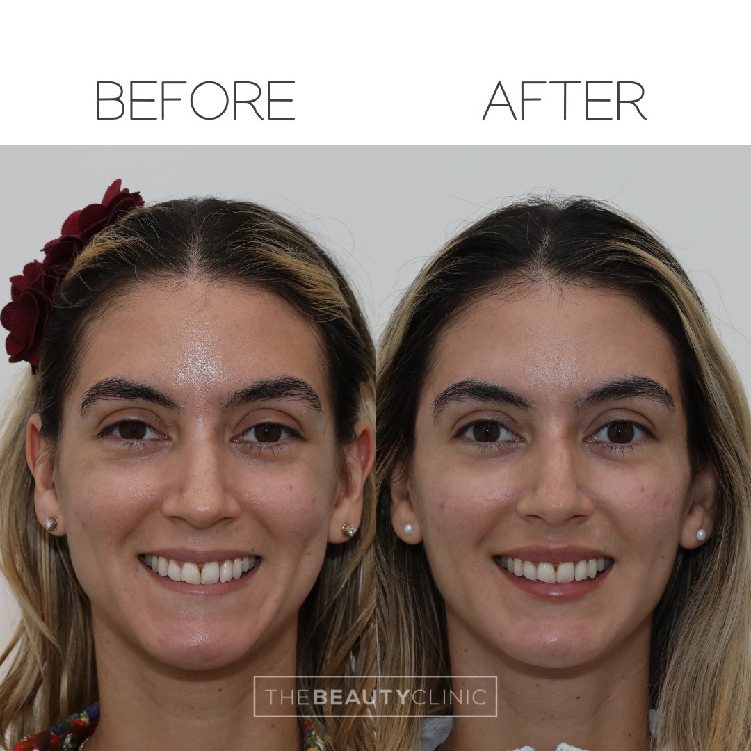 The beauty clinic - Facial Balancing with Filler - Before and after - filler