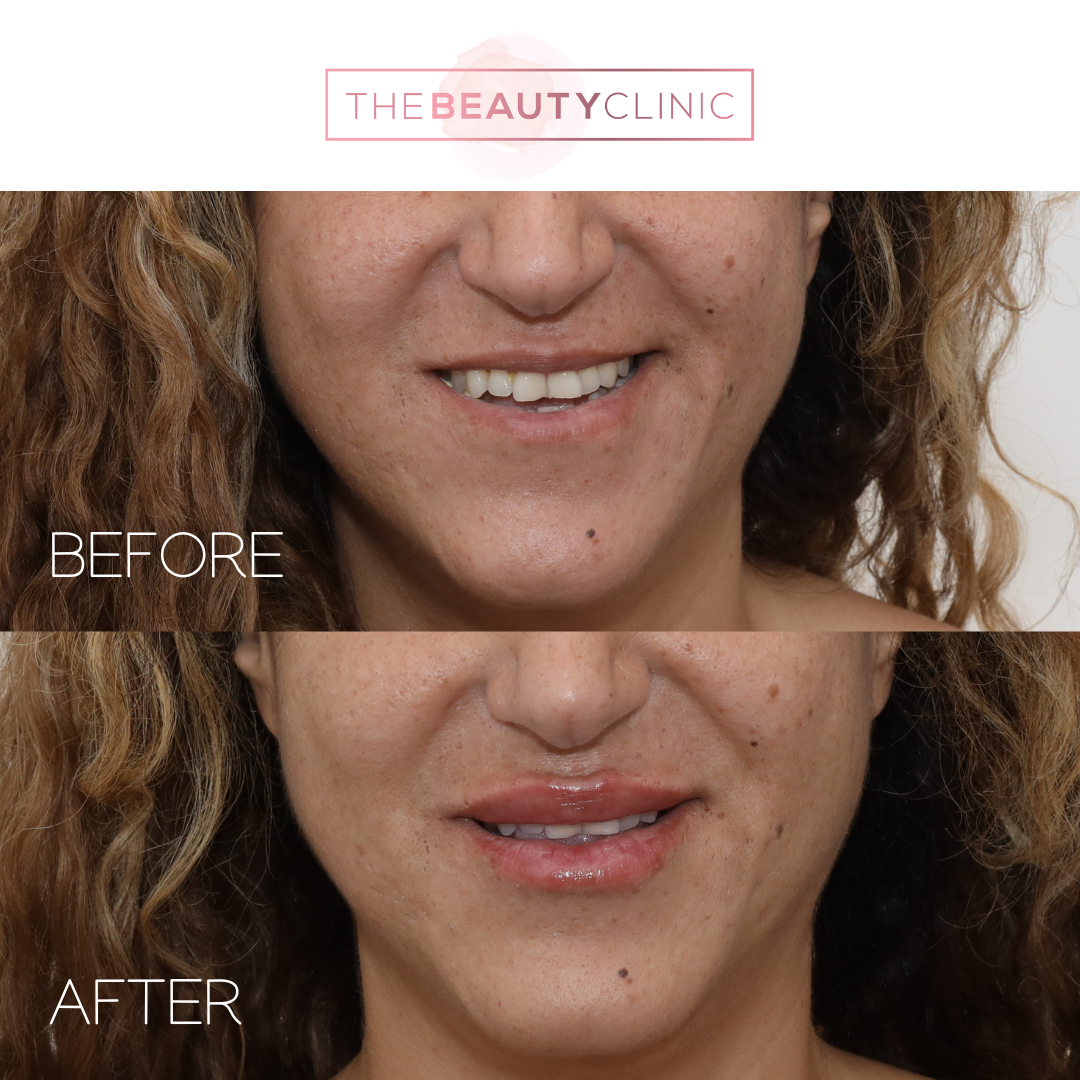 Lip Filler - Before and After - The Beauty Clinic