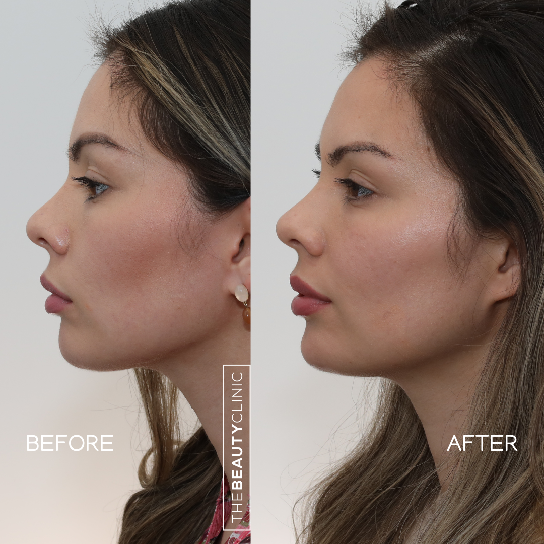 The beauty clinic - Facial Balancing with Filler - Before and after - filler