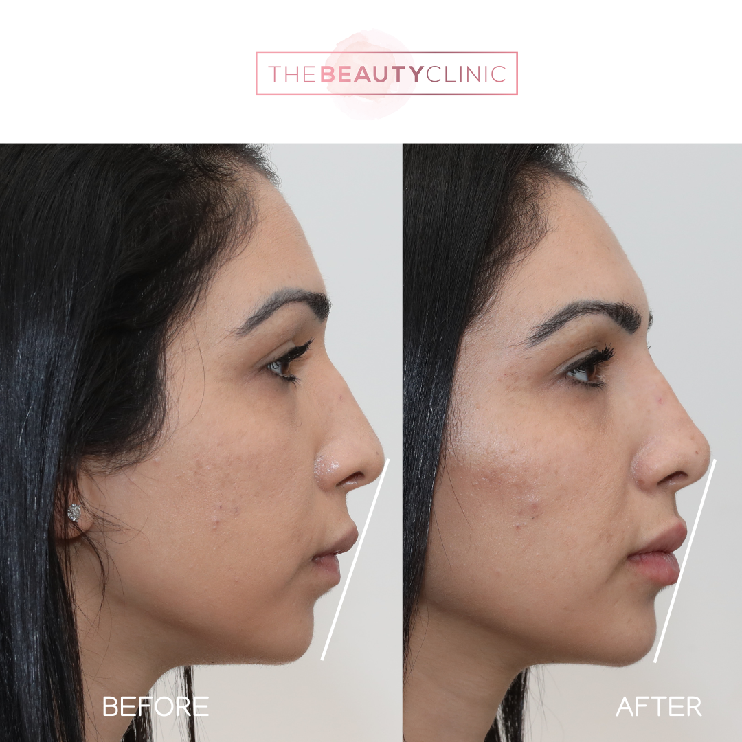 Lip Filler - Before and After - The Beauty Clinic