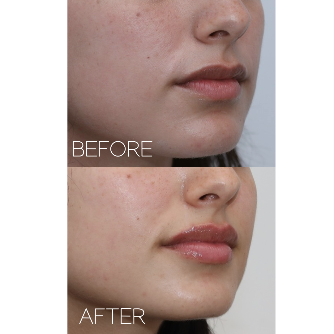 Lip Filler - Before and After - The Beauty Clinic