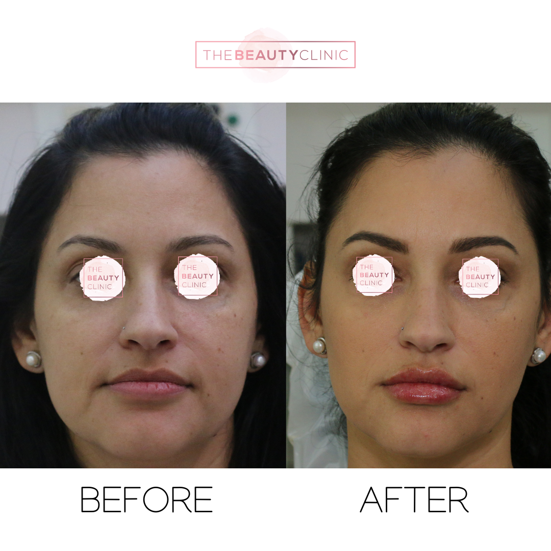 The beauty clinic - Facial Balancing with Filler - Before and after - filler