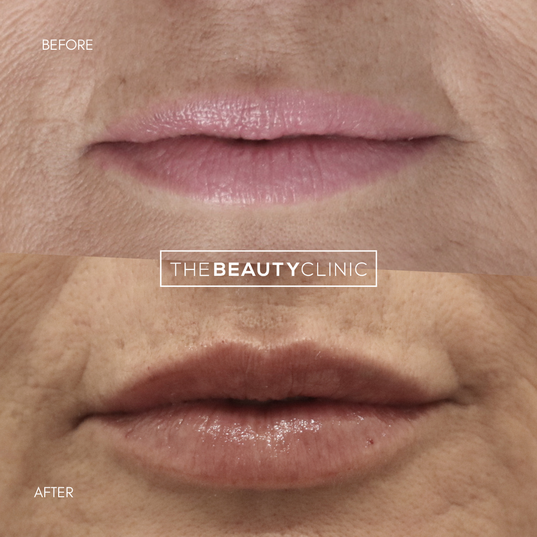 Lip Filler - Before and After - The Beauty Clinic