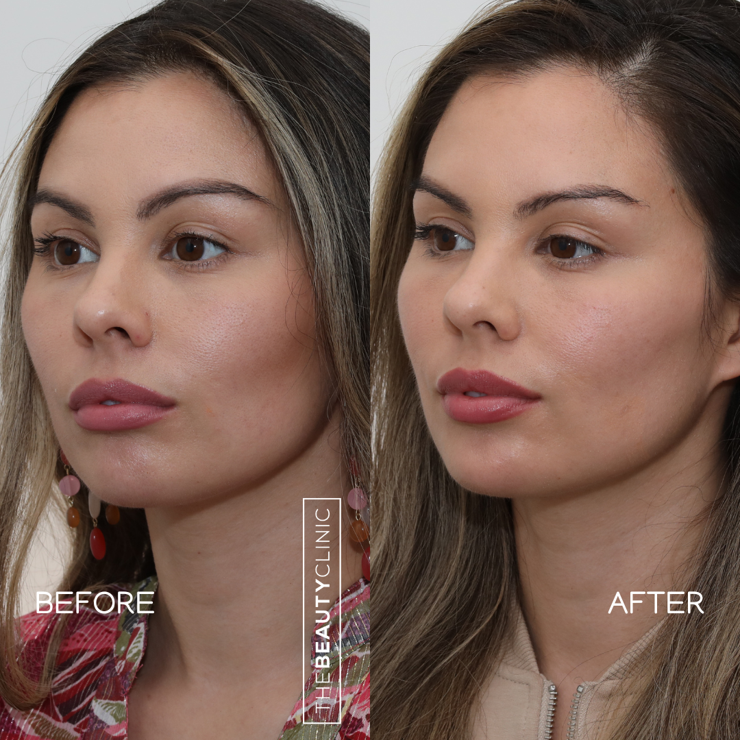 The beauty clinic - Facial Balancing with Filler - Before and after - filler