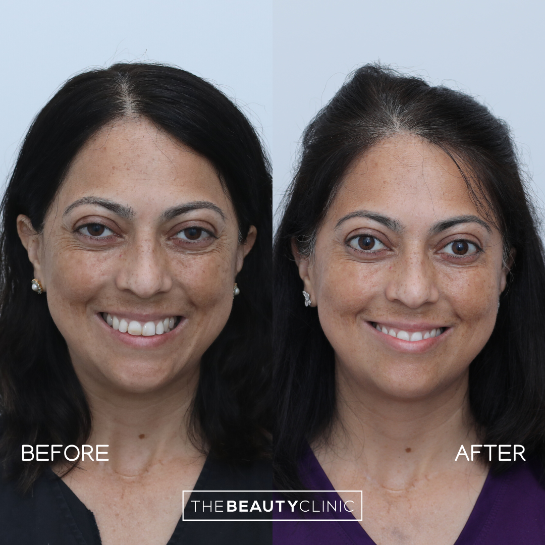 The beauty clinic - Facial Balancing with Filler - Before and after - filler