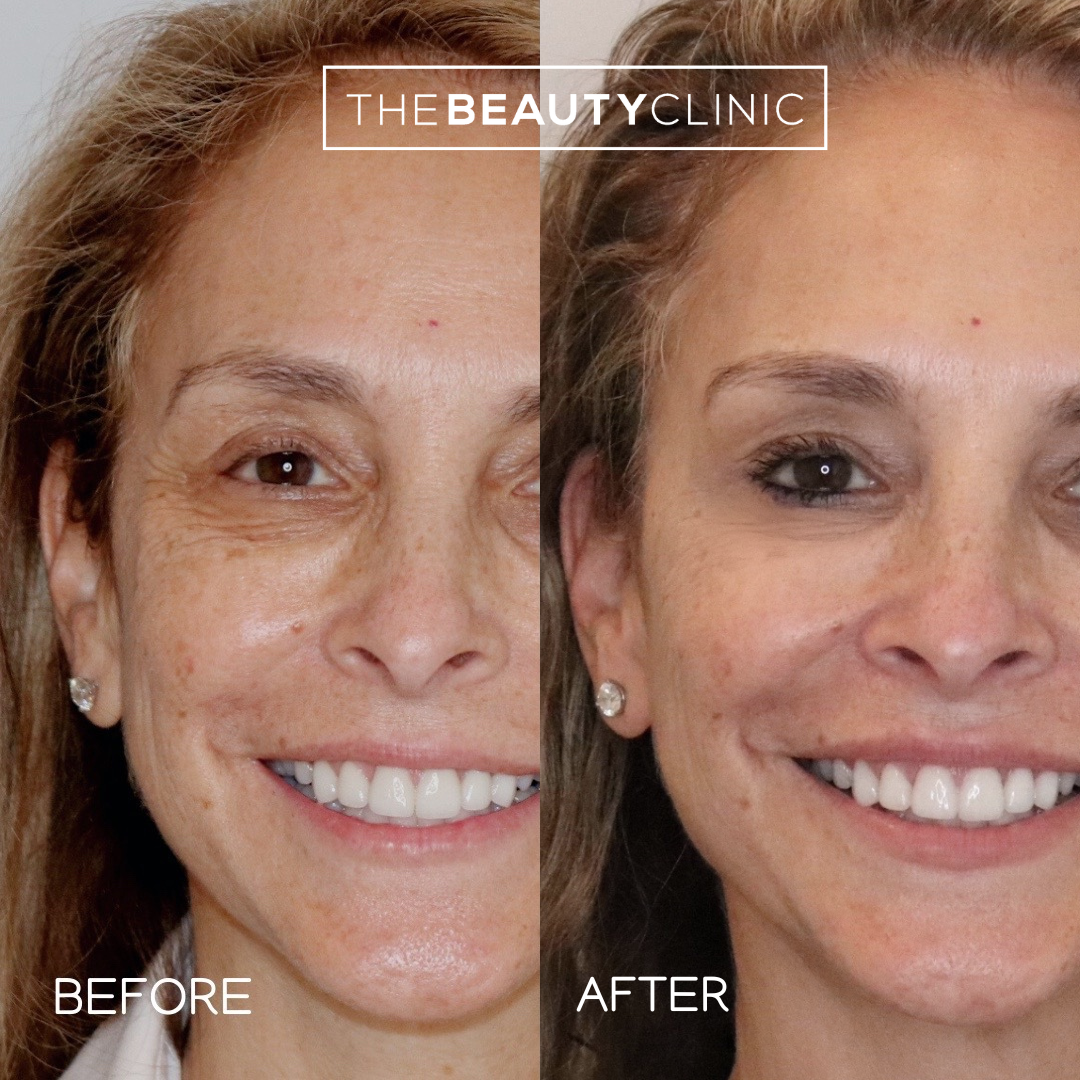 The beauty clinic - Facial Balancing with Filler - Before and after - filler