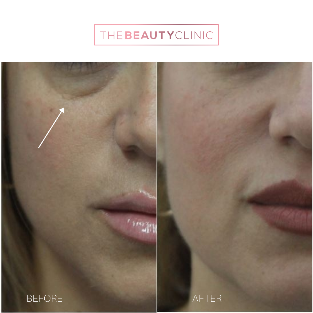 The beauty clinic - Facial Balancing with Filler - Before and after - filler