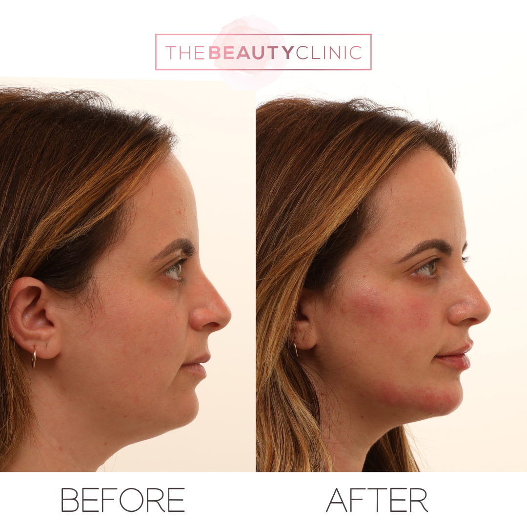 The beauty clinic - Facial Balancing with Filler - Before and after - filler