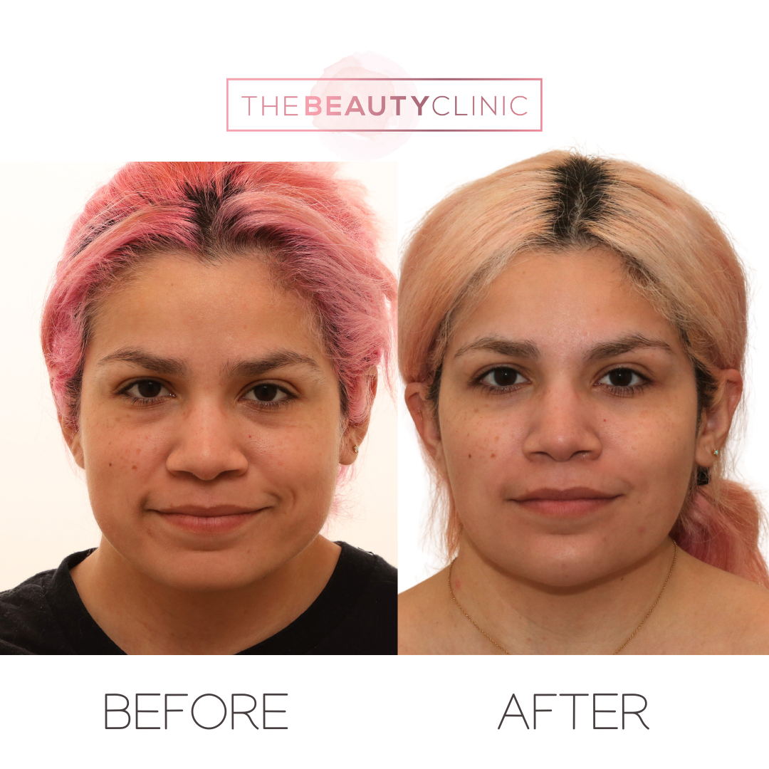 The beauty clinic - Facial Balancing with Filler - Before and after - filler