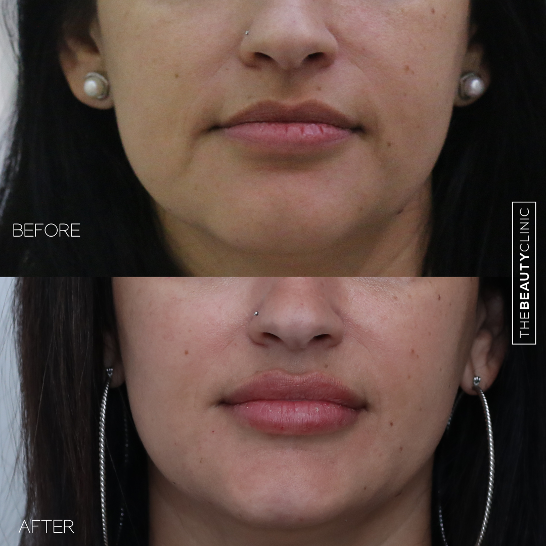 The beauty clinic - Facial Balancing with Filler - Before and after - filler