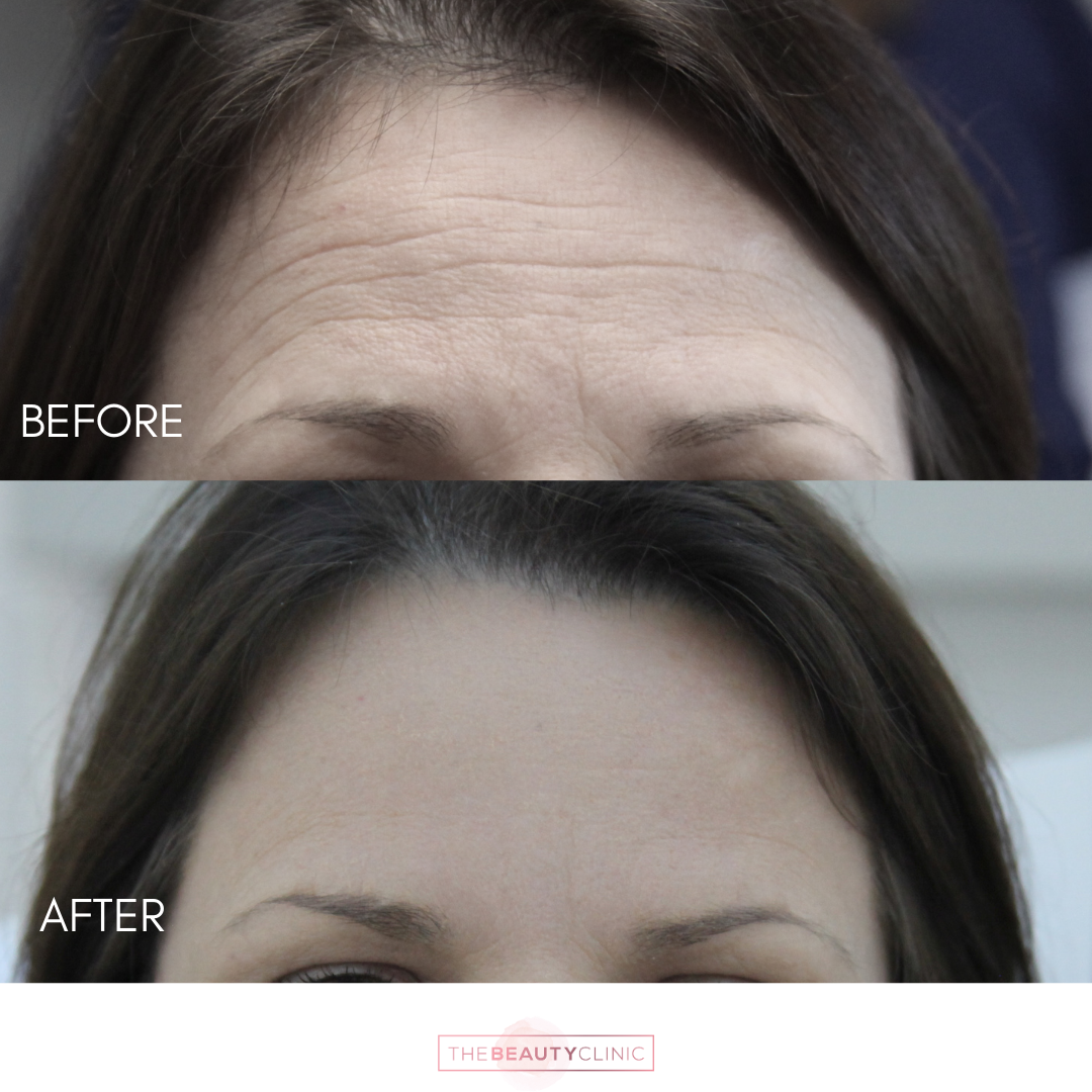 The Beauty Clinic - Toxins - Before and After