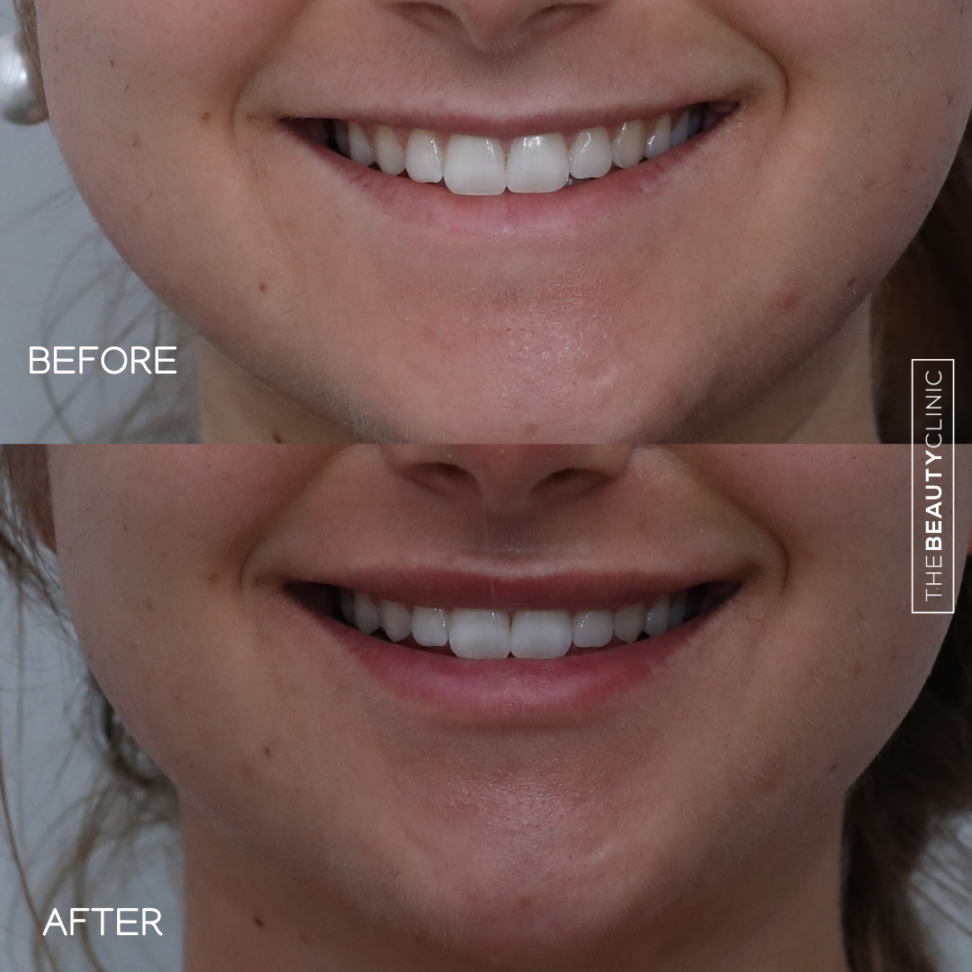 Lip Filler - Before and After - The Beauty Clinic