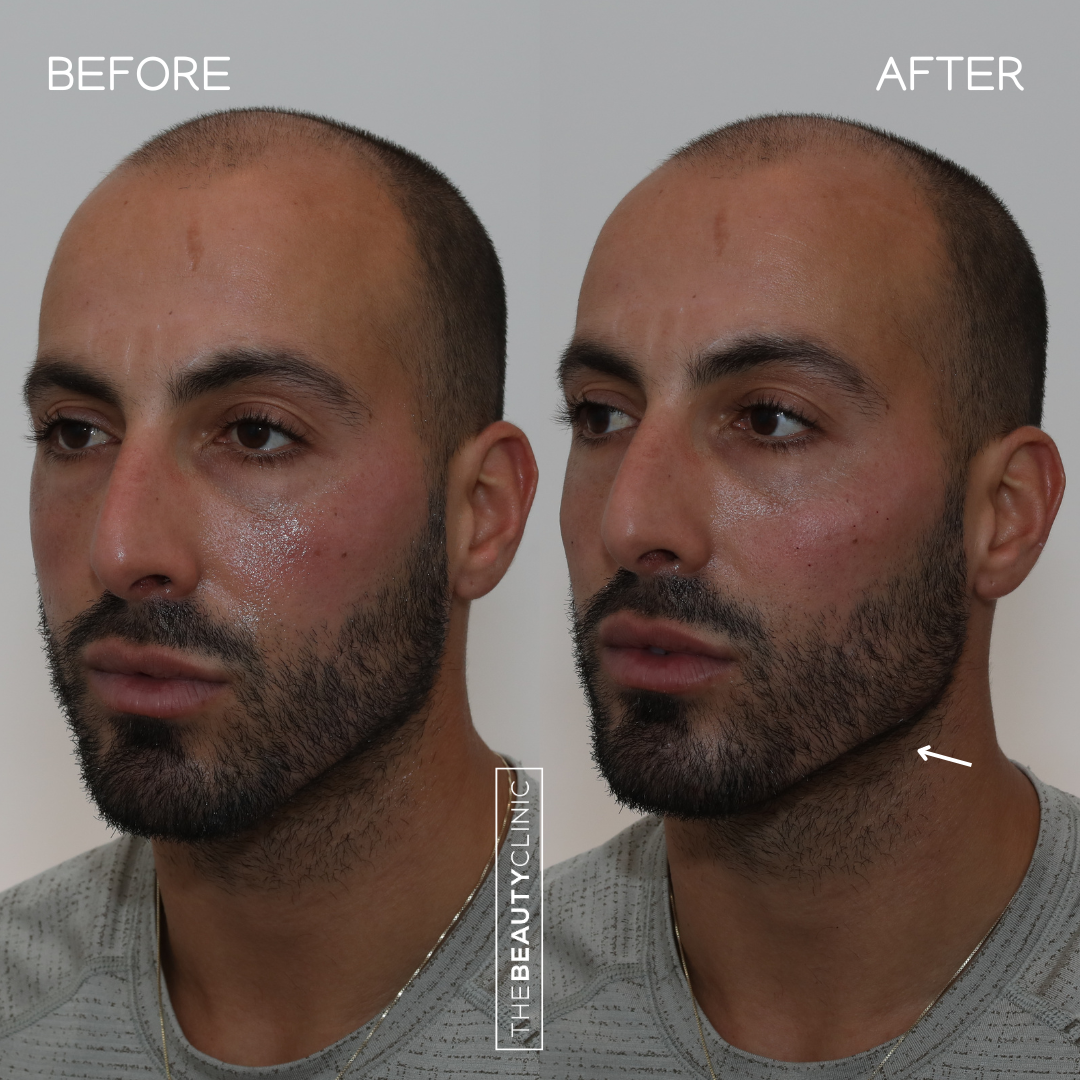 Jawline filler - Before and after - The Beauty Clinic