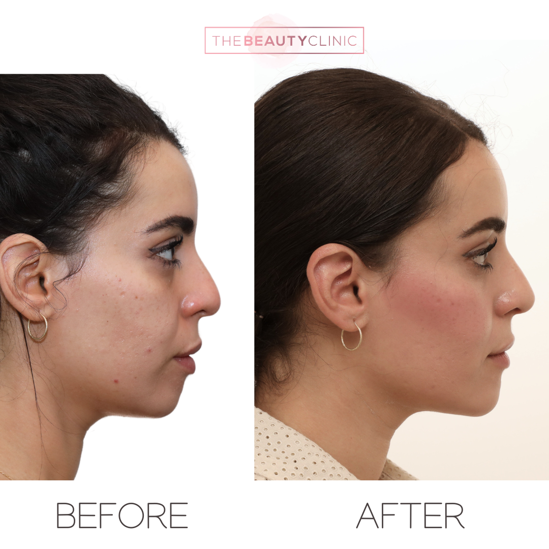 Chin filler - Before and after - The Beauty Clinic