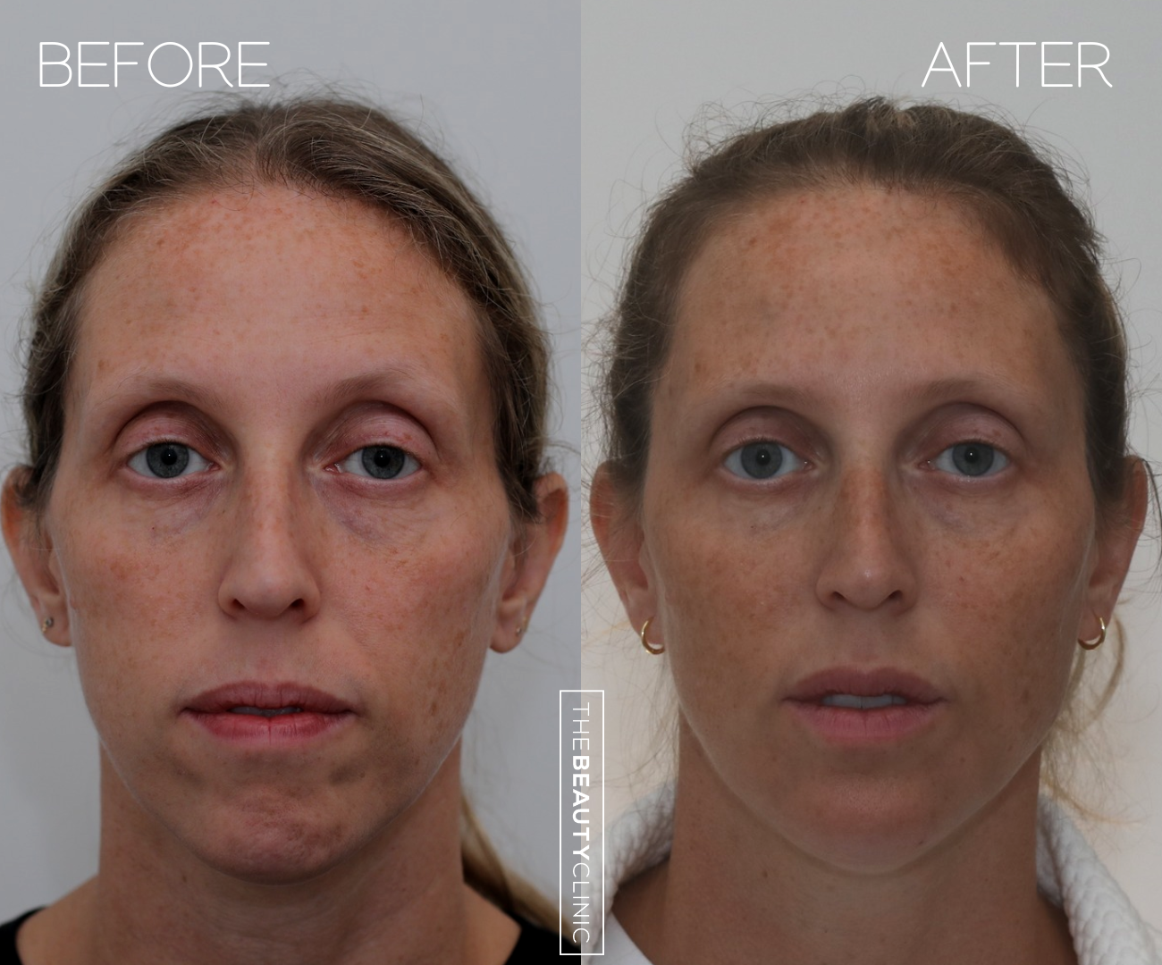 The beauty clinic - Facial Balancing with Filler - Before and after - filler