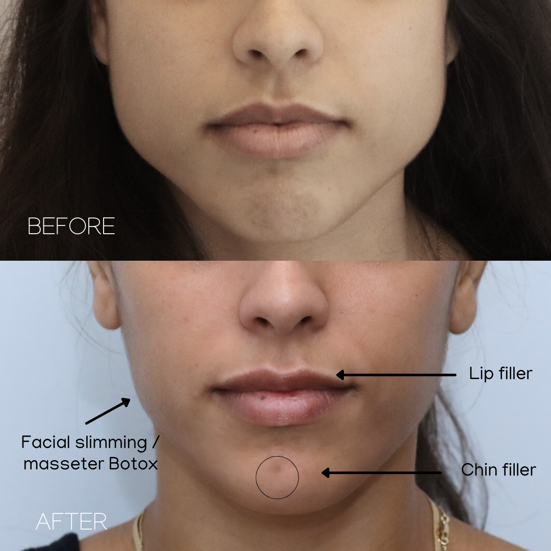 The beauty clinic - Facial Balancing with Filler - Before and after - filler