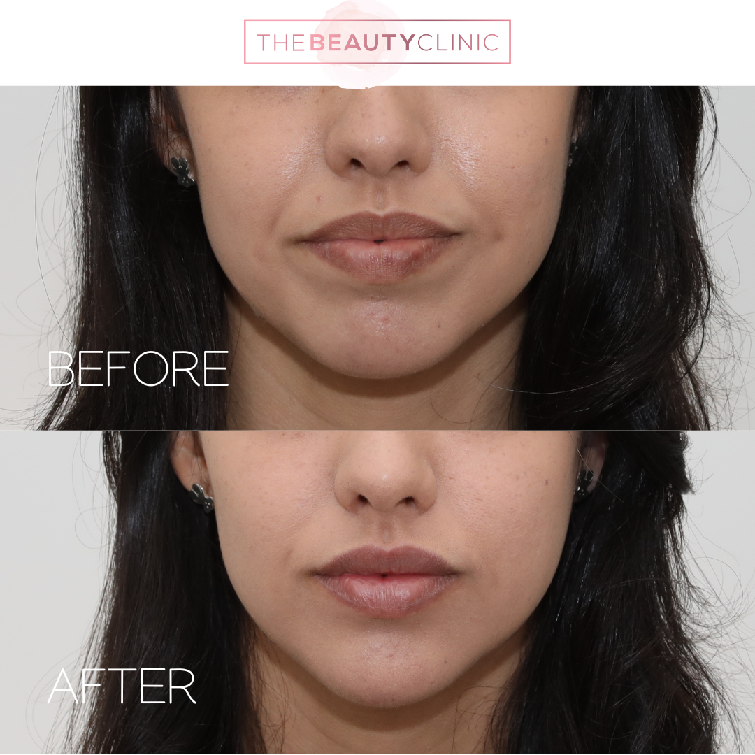 Lip Filler - Before and After - The Beauty Clinic