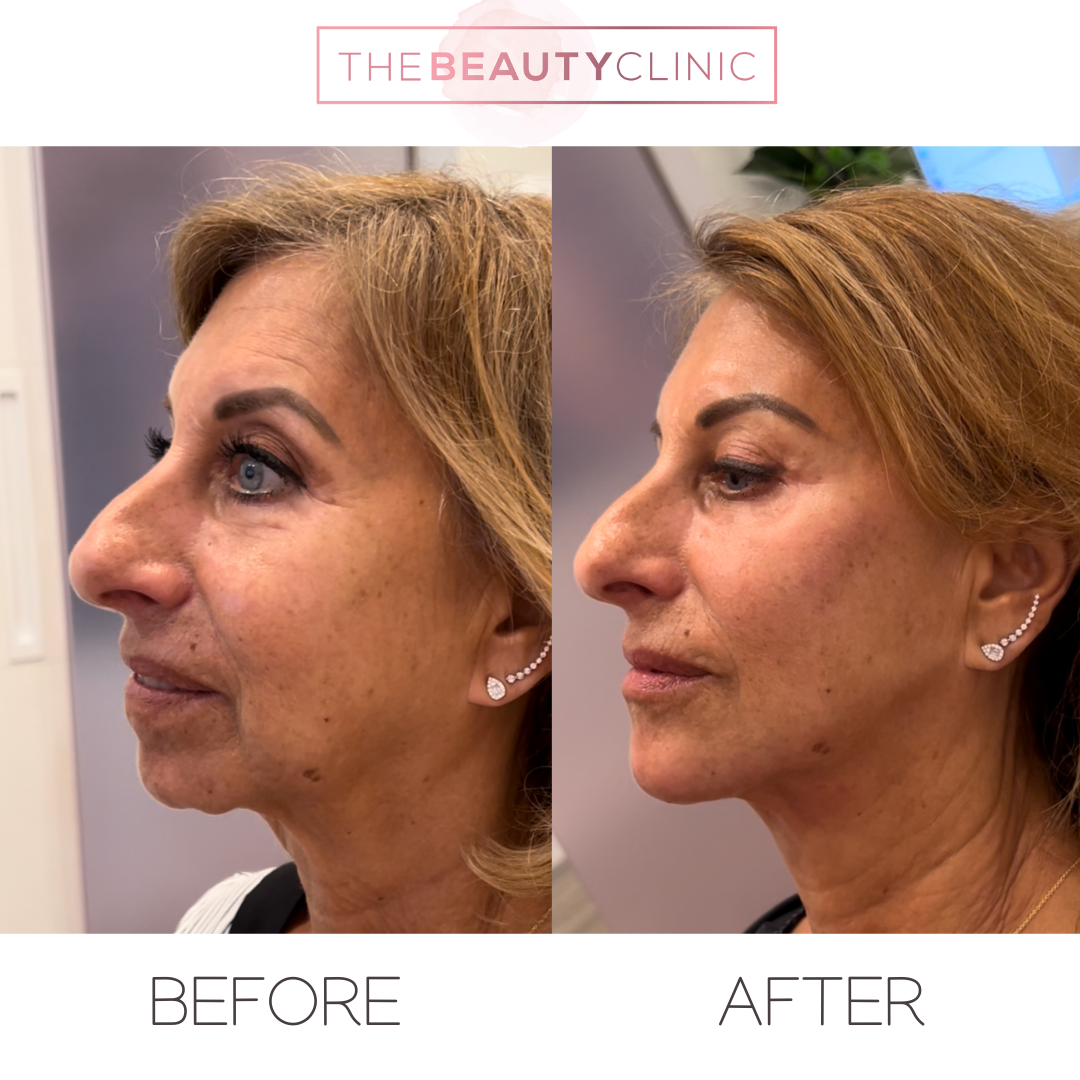 The beauty clinic - Facial Balancing with Filler - Before and after - filler