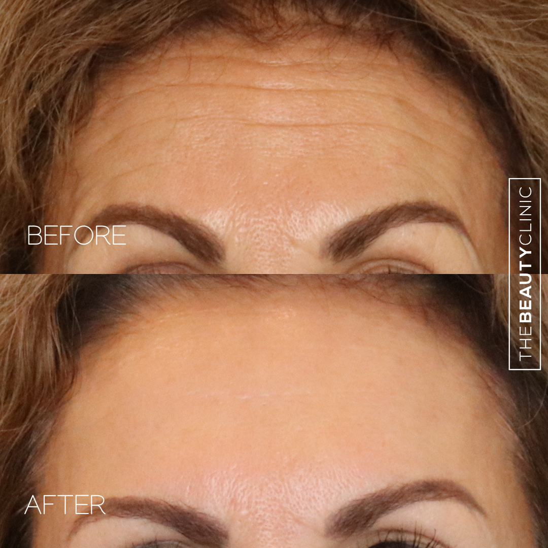 The Beauty Clinic - Toxins - Before and After