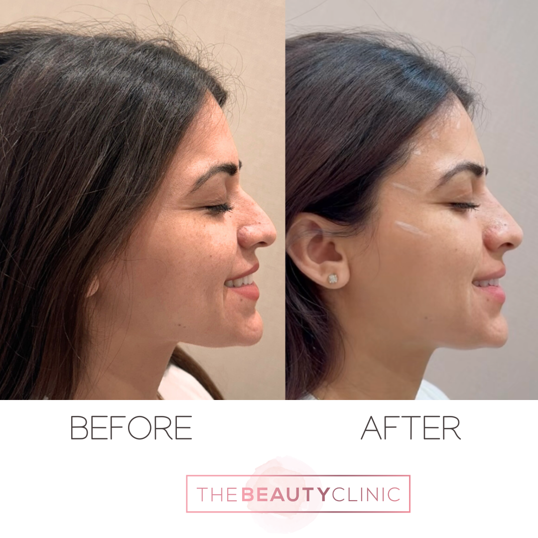 Nose Filler - Before and After - The Beauty Clinic