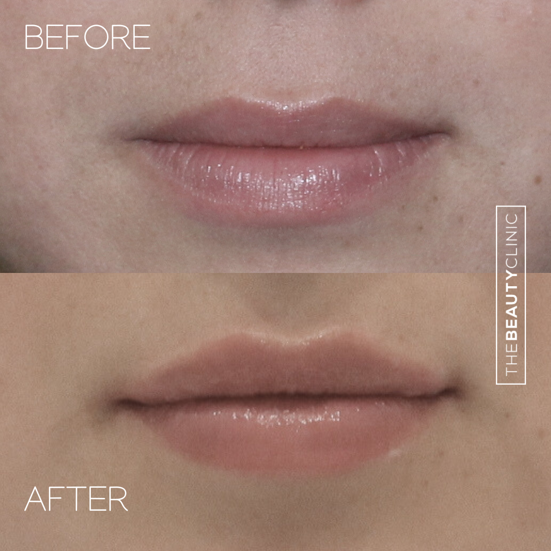 Lip Filler - Before and After - The Beauty Clinic