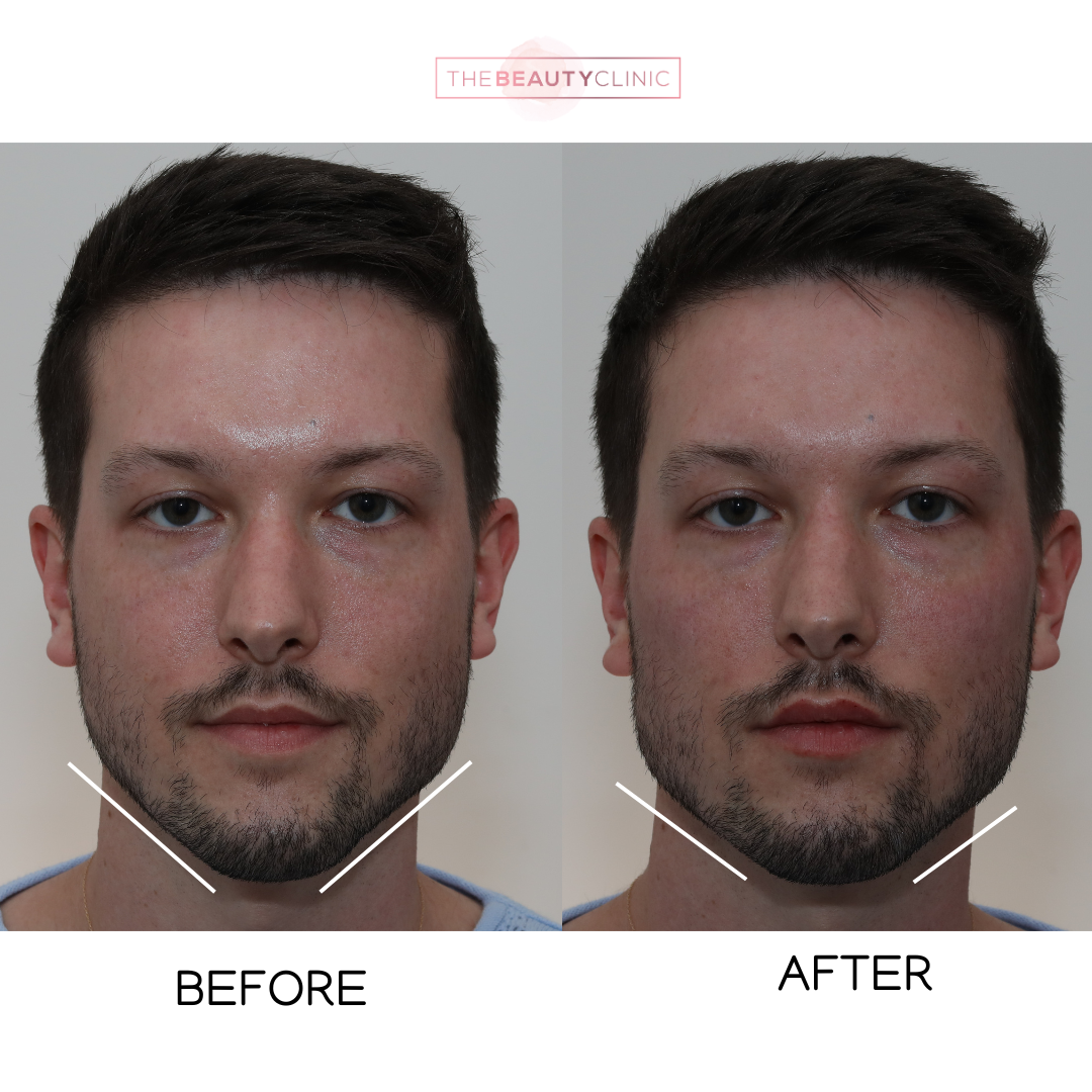 Jawline filler - Before and after - The Beauty Clinic