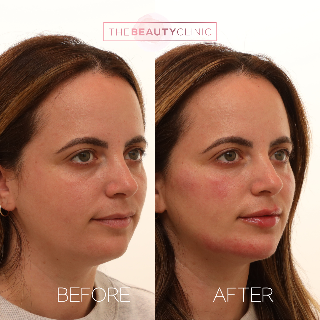 The beauty clinic - Facial Balancing with Filler - Before and after - filler