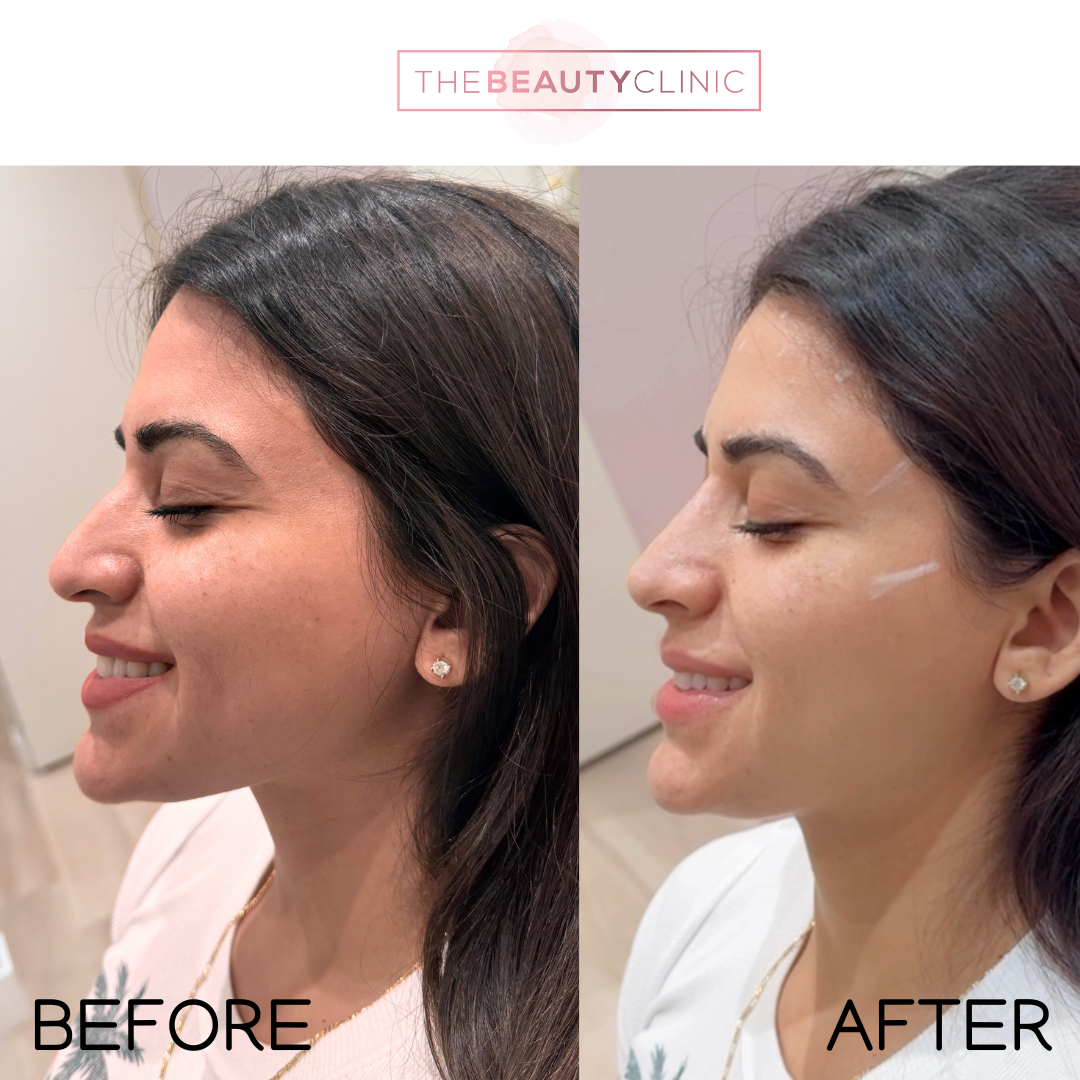 Nose Filler - Before and After - The Beauty Clinic