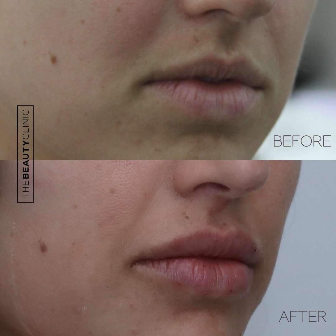 Lip Filler - Before and After - The Beauty Clinic