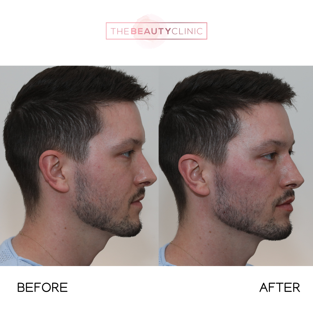 Jawline filler - Before and after - The Beauty Clinic