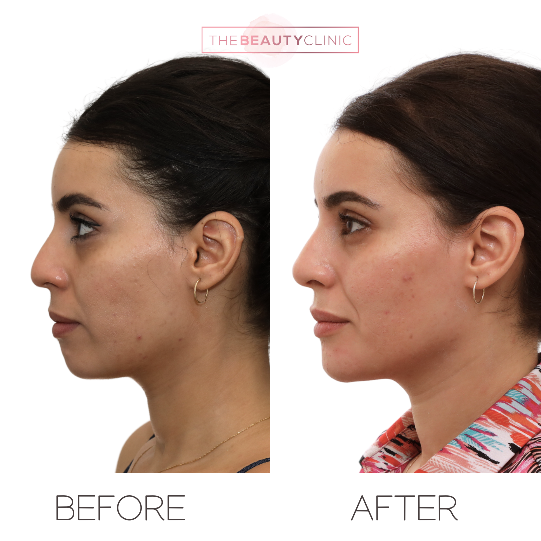 Chin filler - Before and after - The Beauty Clinic