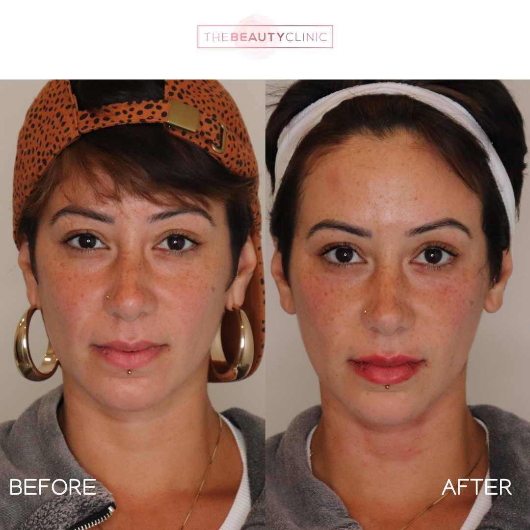 The beauty clinic - Facial Balancing with Filler - Before and after - filler