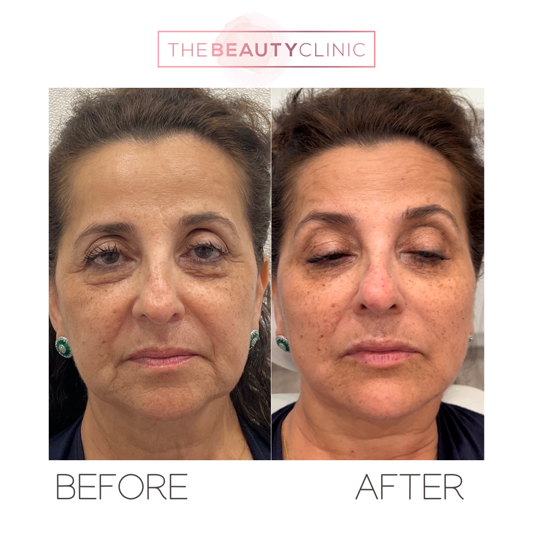 The beauty clinic - Facial Balancing with Filler - Before and after - filler