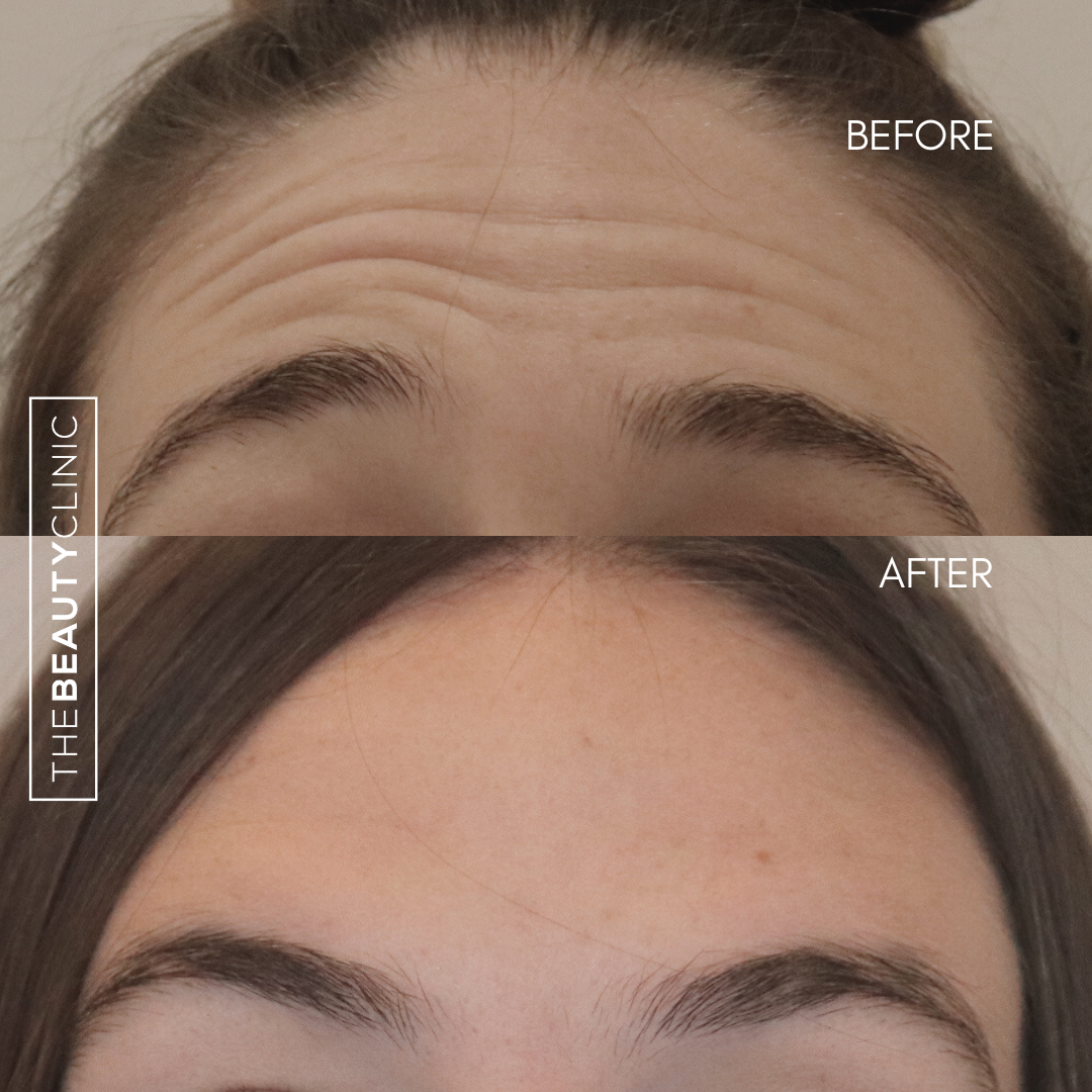 The Beauty Clinic - Toxins - Before and After