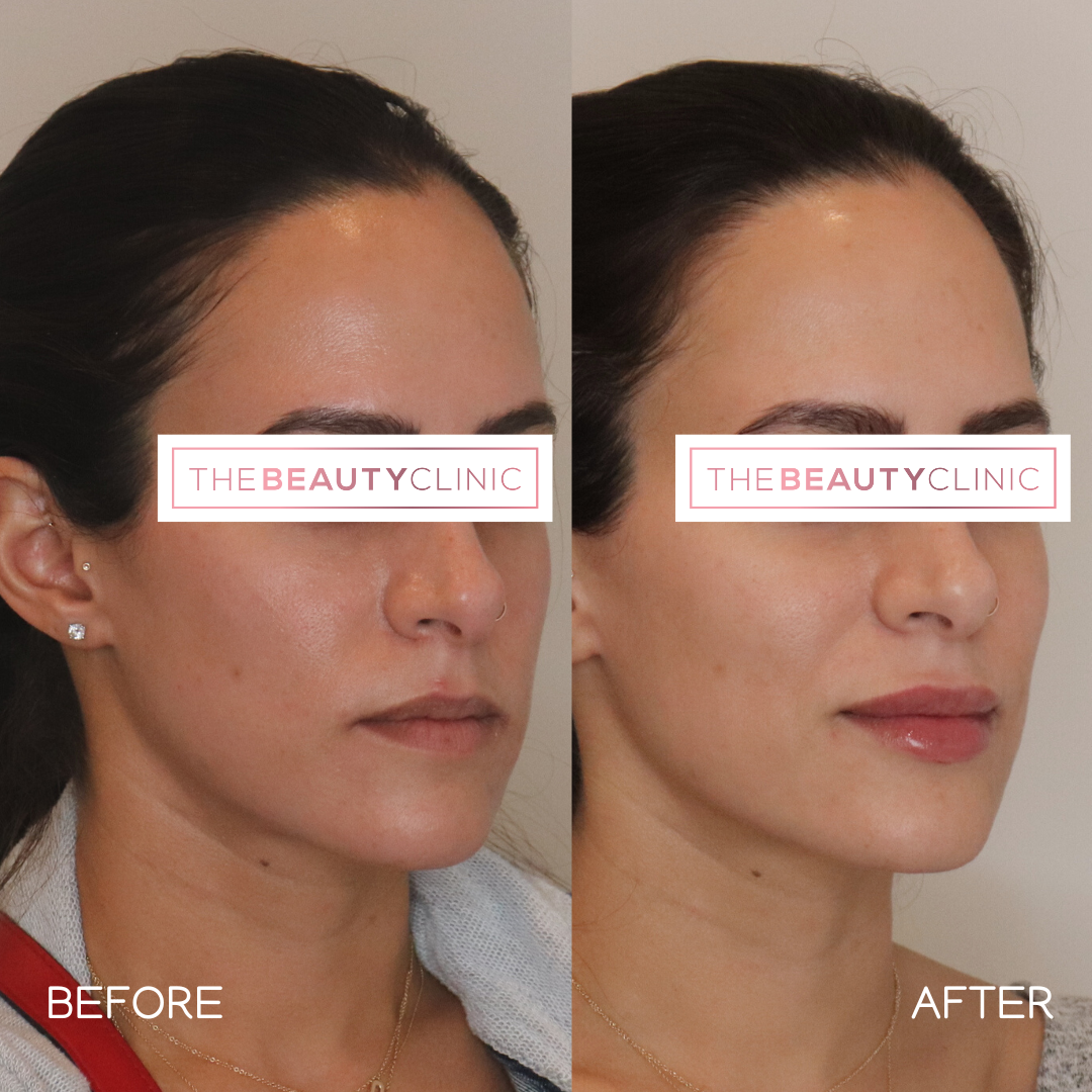 Lip Filler - Before and After - The Beauty Clinic