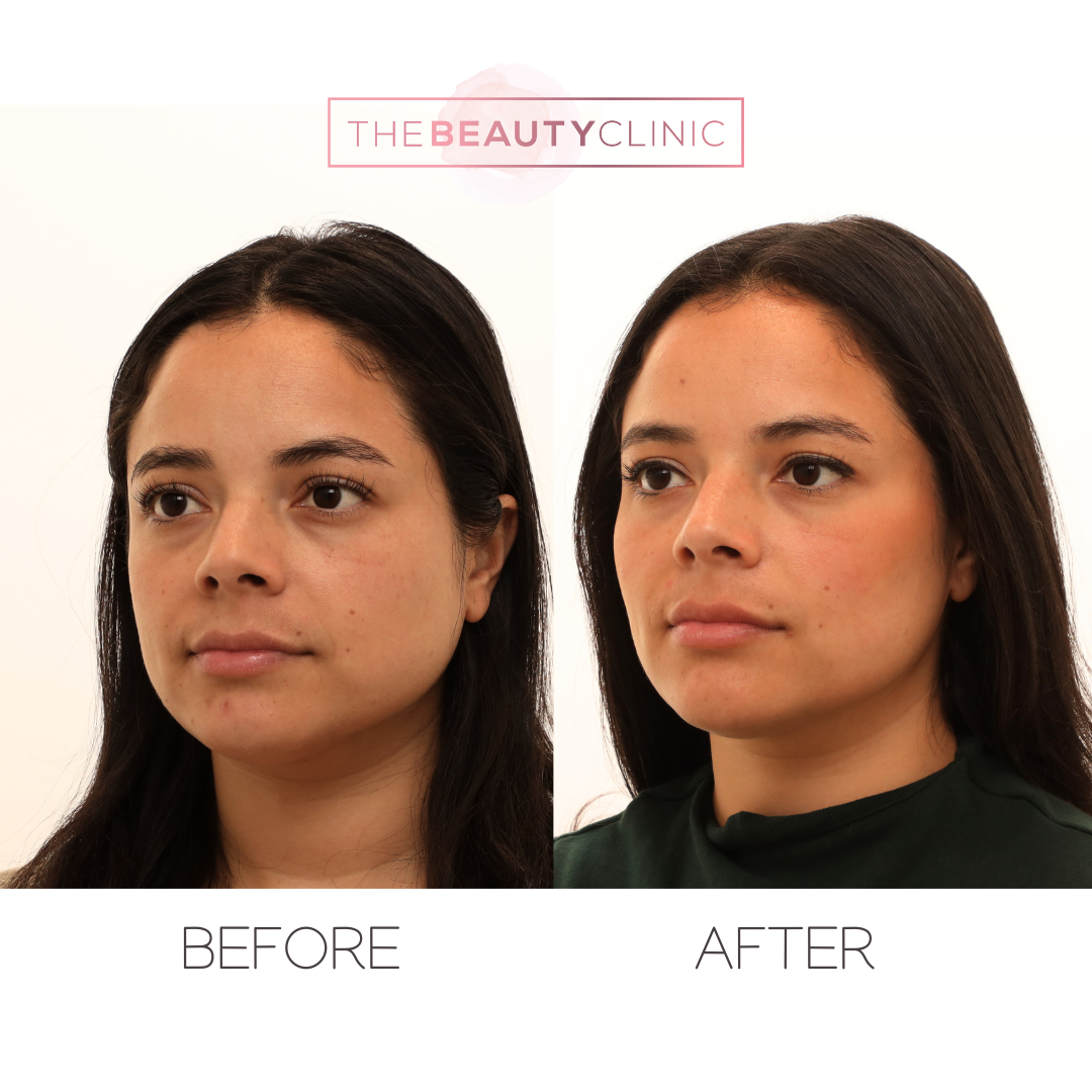 The beauty clinic - Facial Balancing with Filler - Before and after - filler