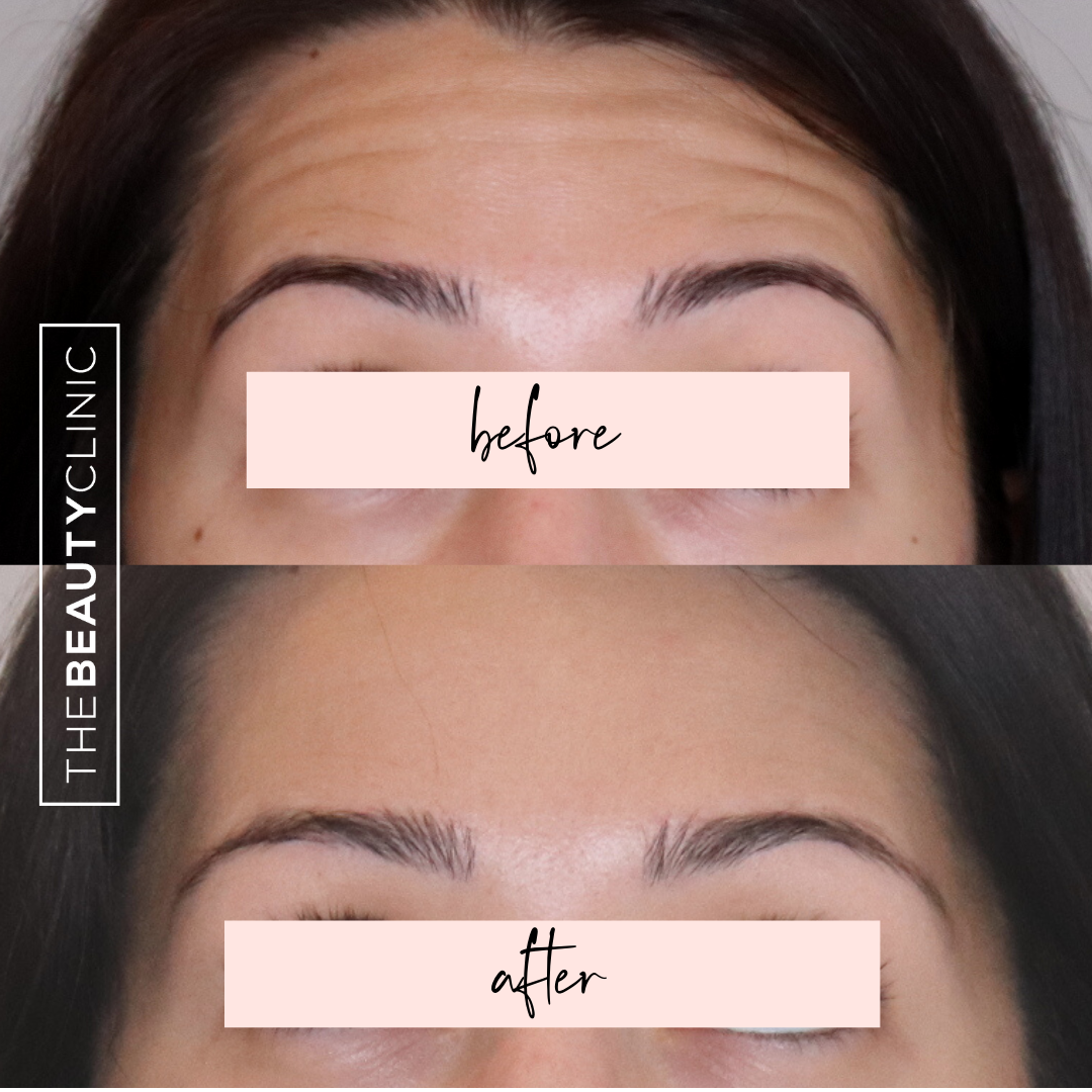 The Beauty Clinic - Toxins - Before and After