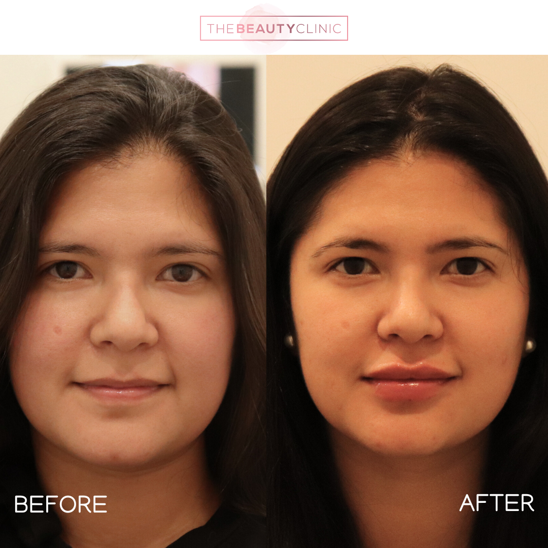 Lip Filler - Before and After - The Beauty Clinic