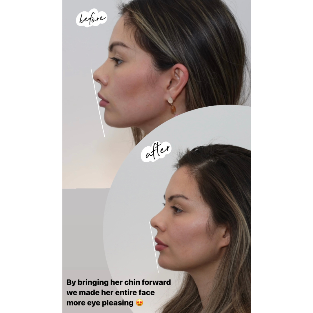 Chin filler - Before and after - The Beauty Clinic