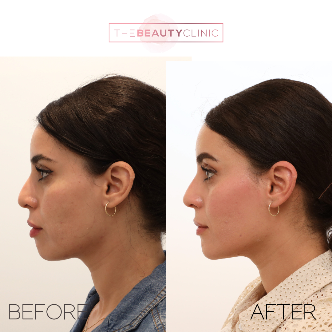 The beauty clinic - Facial Balancing with Filler - Before and after - filler