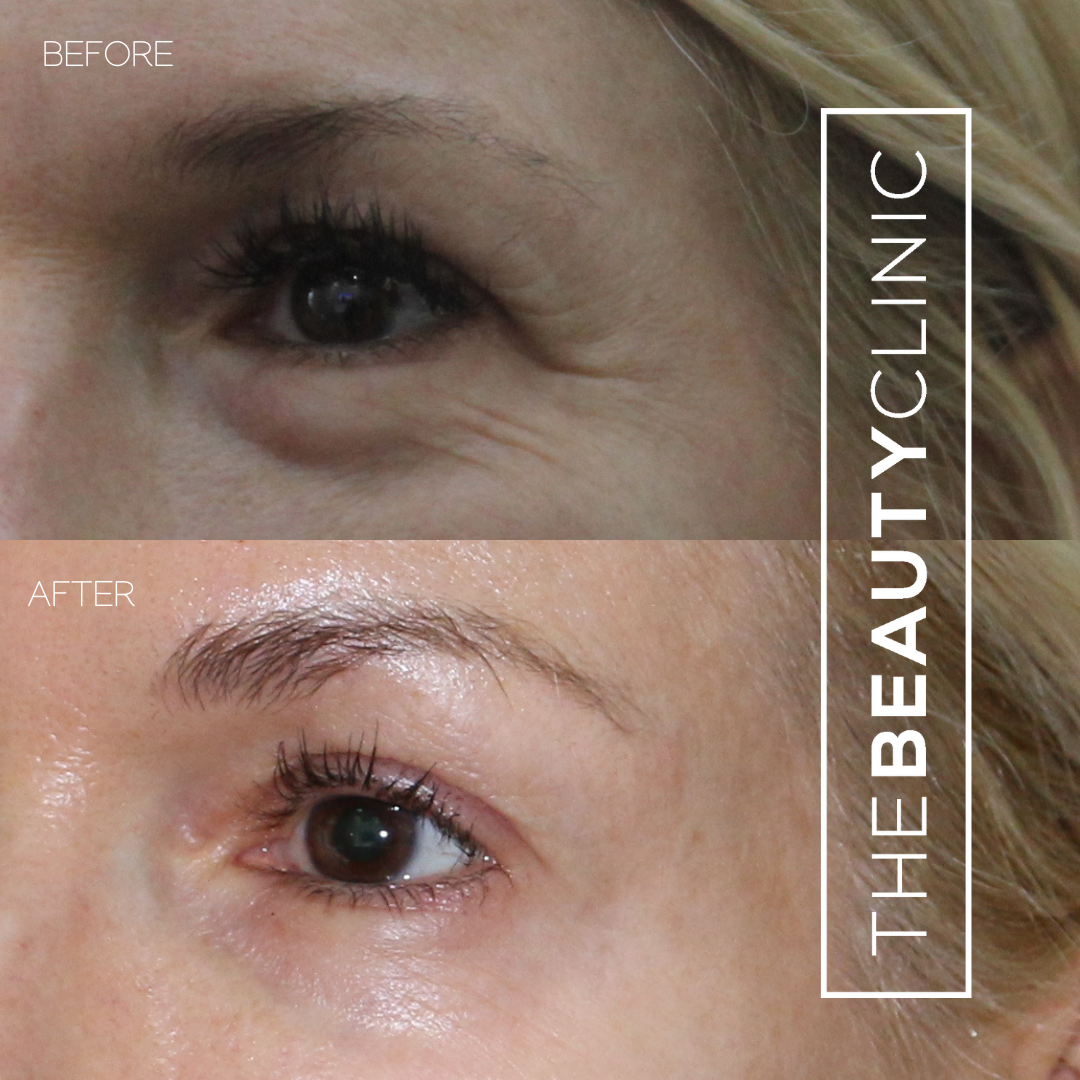 The Beauty Clinic - Toxins - Before and After