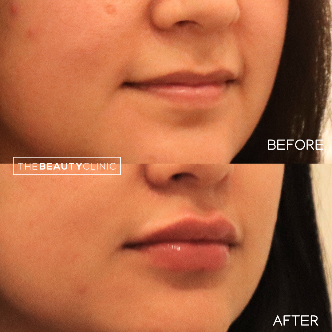 Lip Filler - Before and After - The Beauty Clinic