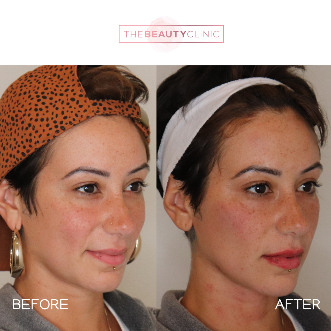 The beauty clinic - Facial Balancing with Filler - Before and after - filler